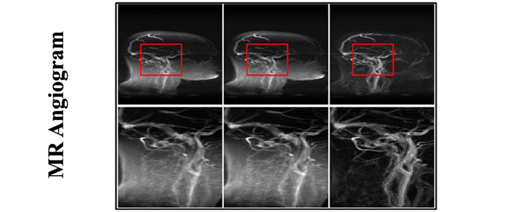 MR Angiogram